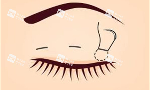 双眼皮划线展示图 双眼皮划线展示图