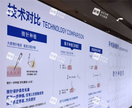 温州大麦植发技术简介 温州大麦植发技术简介