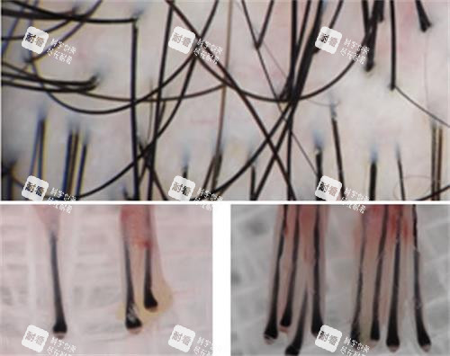 头皮放大毛囊细节图