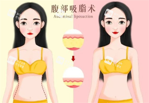 宋建星医生吸脂怎么预约？线上+线下全攻略+2025吸脂全新价格表