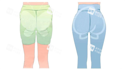 臀部吸脂手术背面对比动画图 臀部吸脂手术背面对比动画图