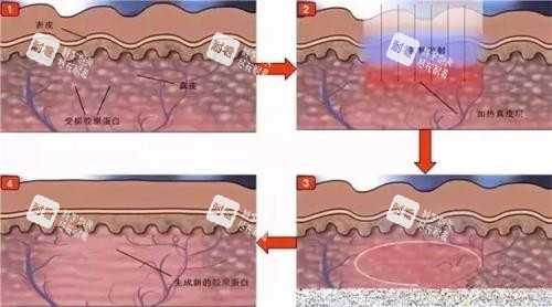 光子嫩肤的步骤 光子嫩肤的步骤