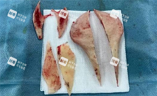 刘双立磨骨适合谁？骨性脸宽/颧骨突出/下颌角外翻，自测指南