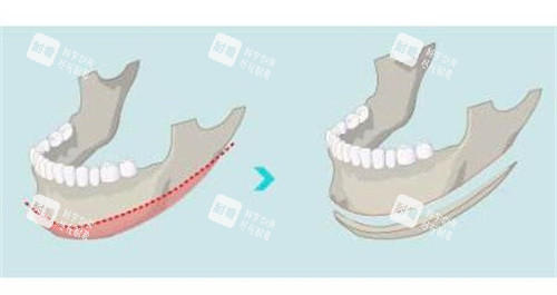 刘双立磨骨怎么样？整友高频10问：预约流程+面诊准备+术后禁忌