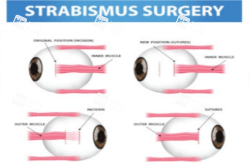 斜视手术前后对比 斜视手术前后对比