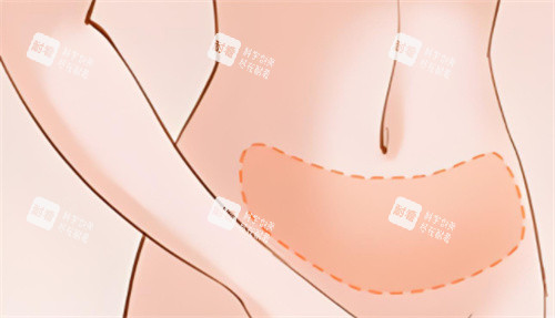吸脂腹部区域 吸脂腹部区域