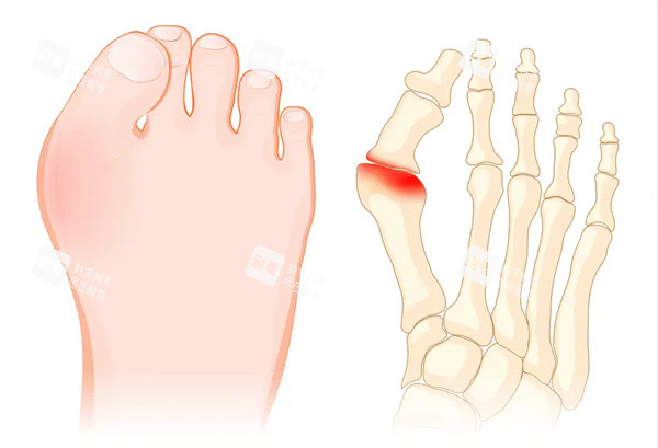 大脚骨矫正术 大脚骨矫正术