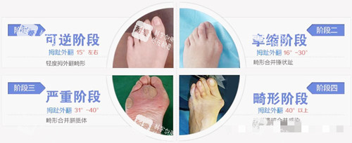 大脚骨类型 大脚骨类型