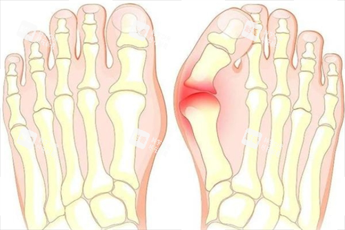 大脚骨脚步骨头透视图 大脚骨脚步骨头透视图