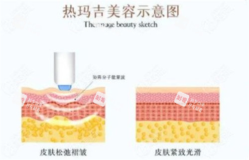 热玛吉美容示意图 热玛吉美容示意图