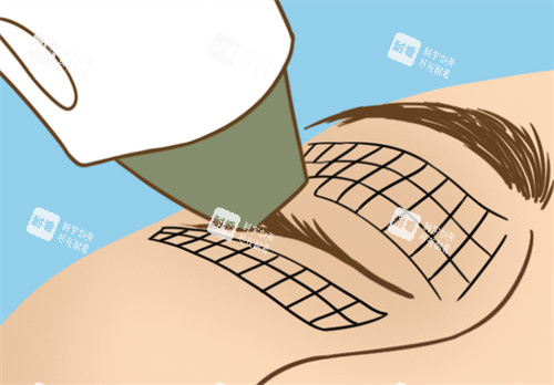 热玛吉眼部抗衰过程图解 热玛吉眼部抗衰过程图解