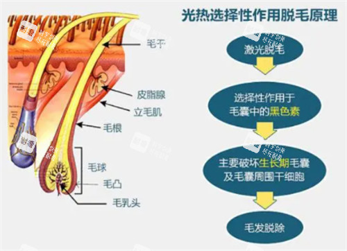 光子脱毛的原理 光子脱毛的原理