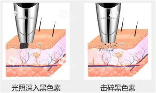 激光去纹身 激光去纹身