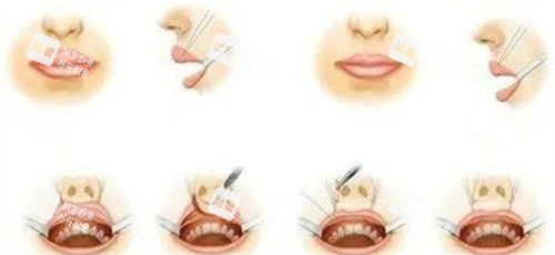 厚唇改薄