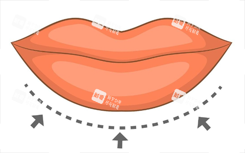 厚唇改薄画线示意图