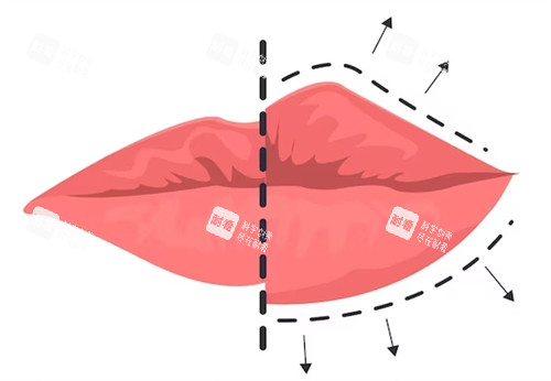 丰唇手术对比图