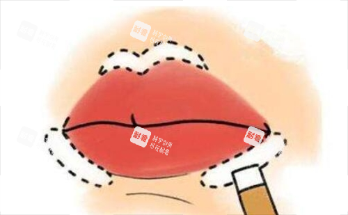 丰唇手术画线示意图