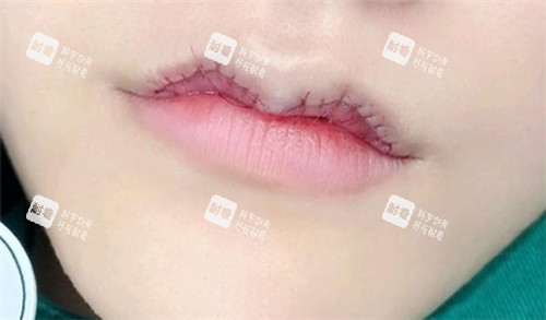 微笑唇手术缝合图片