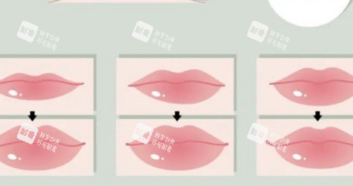 丰唇注射过程示意图