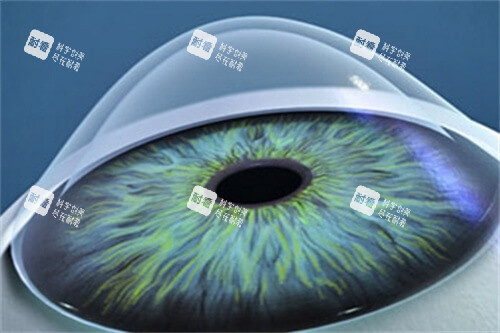 清晰的圆锥角膜示意图