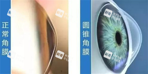 正常角膜与圆锥角膜图片