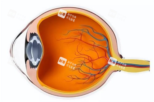 圆锥角膜的示意图