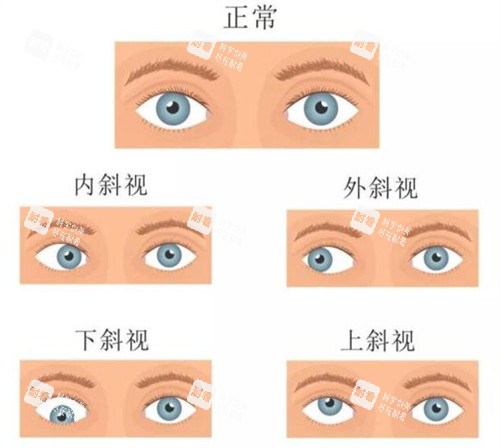 不同情况的斜视眼睛