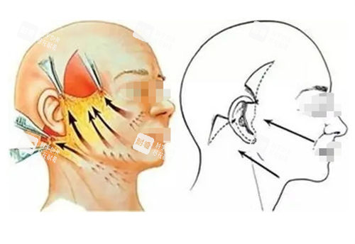 拉皮手术前后提拉对比图 拉皮手术前后提拉对比图