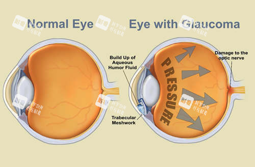 青光眼5 青光眼5