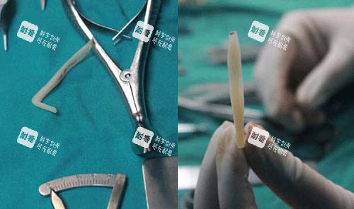 假体雕刻细节图 假体雕刻细节图