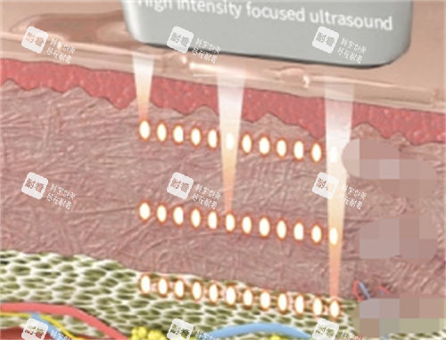 不同激光仪器作用在皮肤的深度展示图 不同激光仪器作用在皮肤的深度展示图