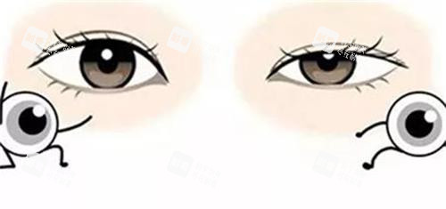 先天小睑裂综合征和正常眼睛的对比