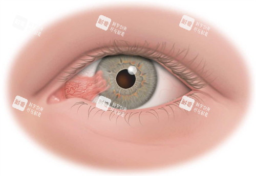 翼状胬肉眼睛