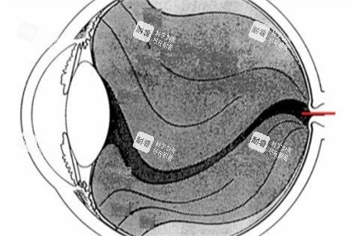 飞蚊症眼球结构