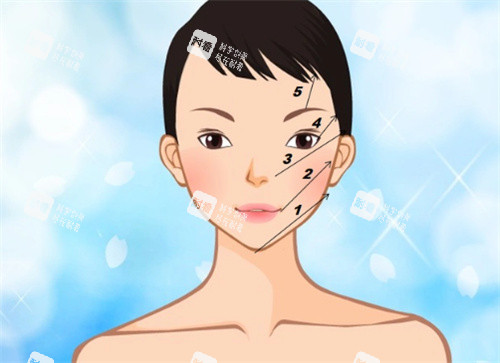 埋线提升 埋线提升