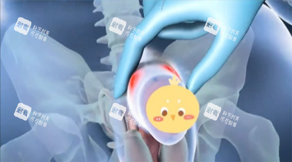 增大增粗手术照片 增大增粗手术照片