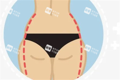 臀部吸脂 臀部吸脂