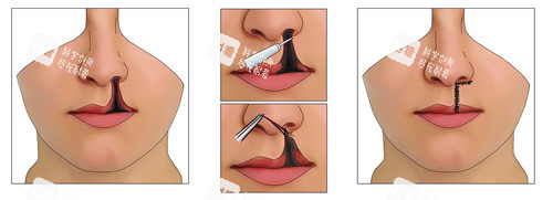 唇裂修复 唇裂修复