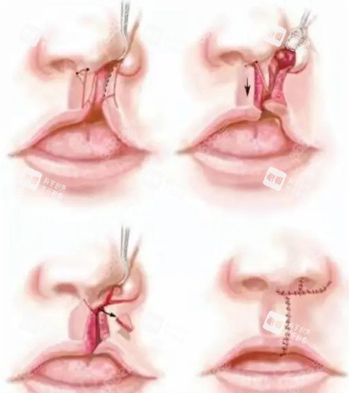 唇裂修复手术卡通图 唇裂修复手术卡通图