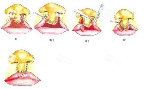 唇裂鼻修复图 唇裂鼻修复图