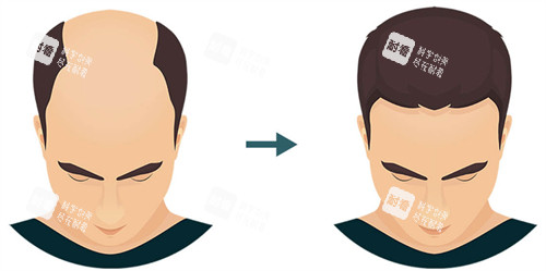 植发前后对比图