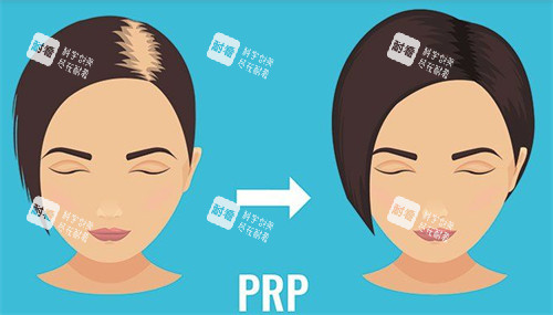 发缝加密植发前后对比图