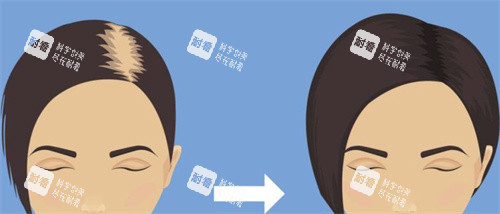植发前后对比示图