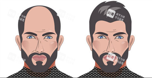 植发前后对比图一览