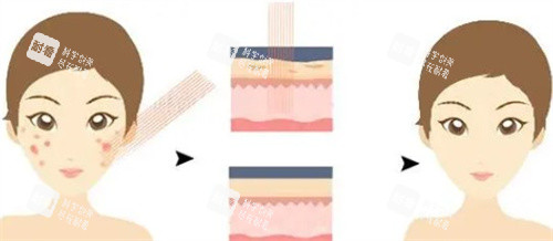 激光去痘印原理 激光去痘印原理