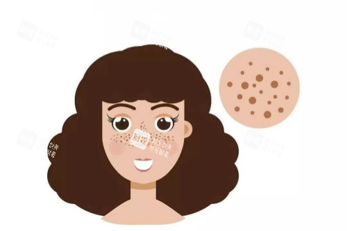 痘印卡通图 痘印卡通图