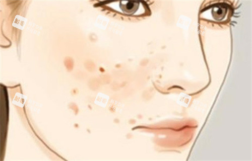 痘痘痘印 痘痘痘印