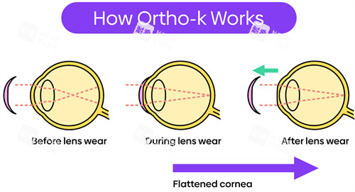 什么是角膜塑形镜