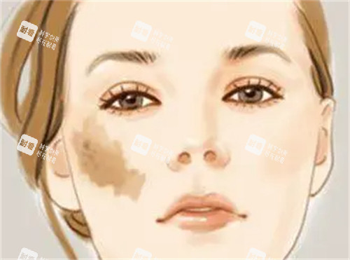 鲜红斑痣的样子 鲜红斑痣的样子