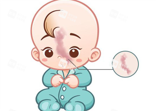 先天鲜红斑痣 先天鲜红斑痣